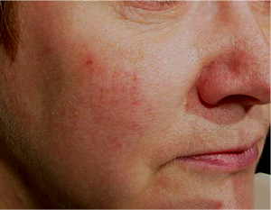 Northern Beaches Skin Medics redness - after